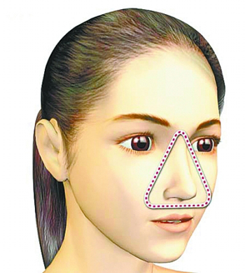 面部“危险三角区”示意图